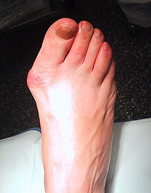 Blog - Bunion Comfort - 02