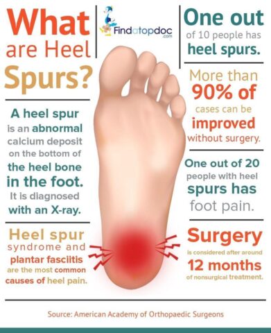 What are Heel Spurs