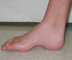 Aiding the Ailment of Clubfoot 2 blog ailment of clubfoot 02