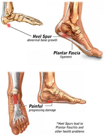 The Curse of Bone Spurs and the Salvation of Medieval Moccasins 1 blog curse of bone spurs 01