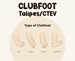 club foot